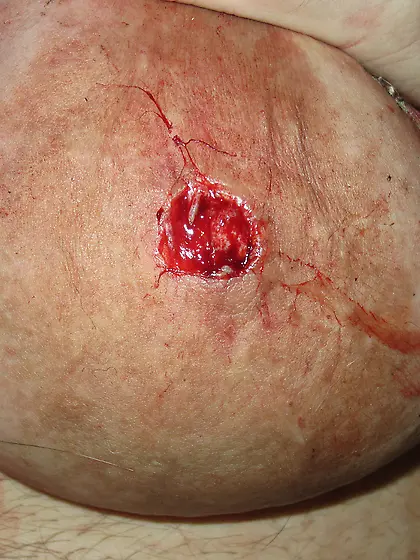 nipple removal video bundle available