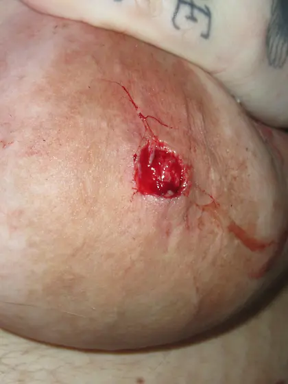 nipple removal video bundle available
