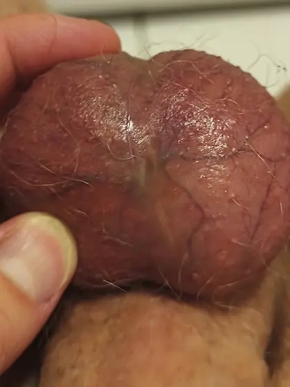 Scars of cutting my balls