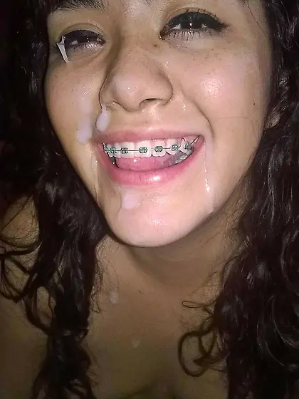 braces
