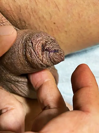 Cut the foreskin in a V shape and stitch it to mak