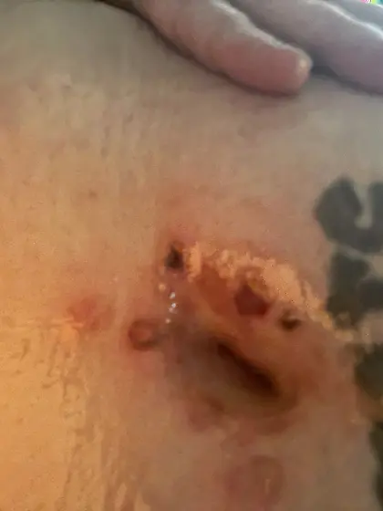 12 hours later (bellybutton ashtray)