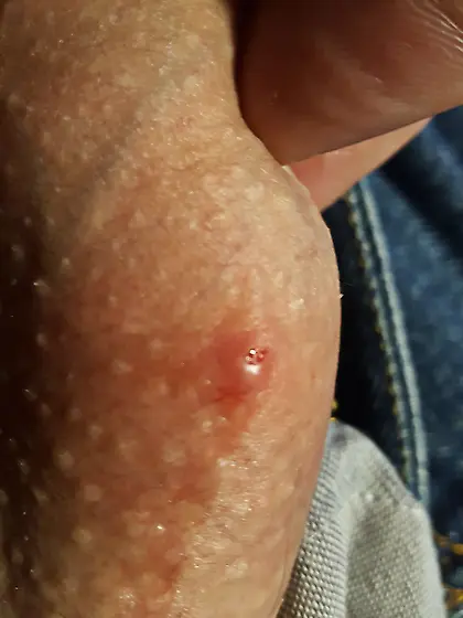 pimple