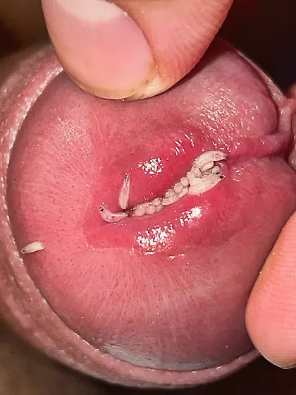 Maggots enter my uretrha and my foreskin