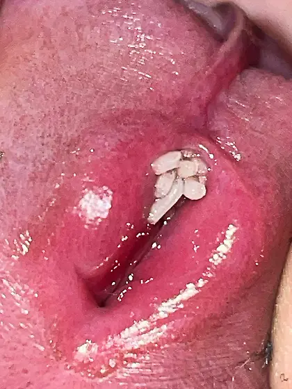 Maggots enter my uretrha and my foreskin