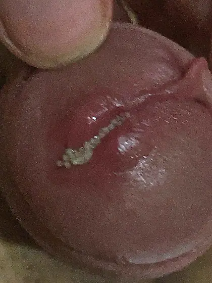 Maggots enter my uretrha and my foreskin