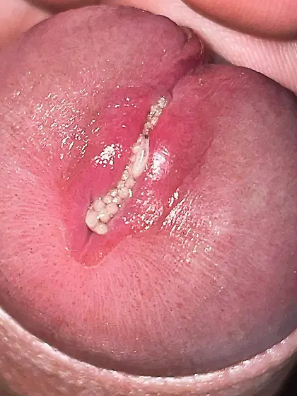 Maggots enter my uretrha and my foreskin