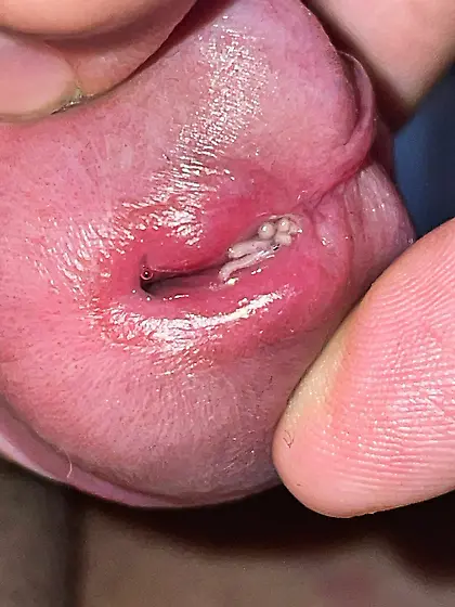 Maggots enter my uretrha and my foreskin