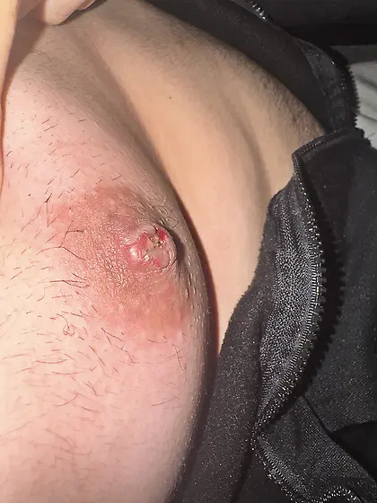 Nipple burned - water under skin
