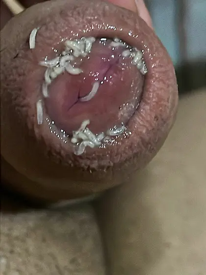 Maggots enter my uretrha and my foreskin