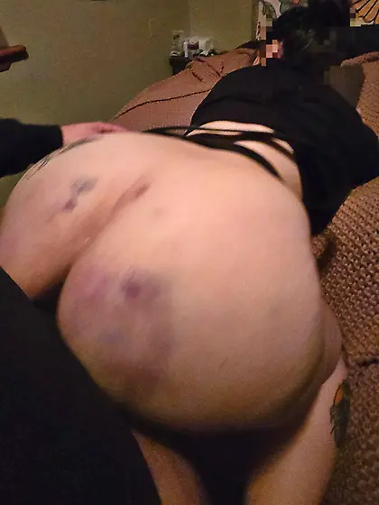 Bruises from my Owner