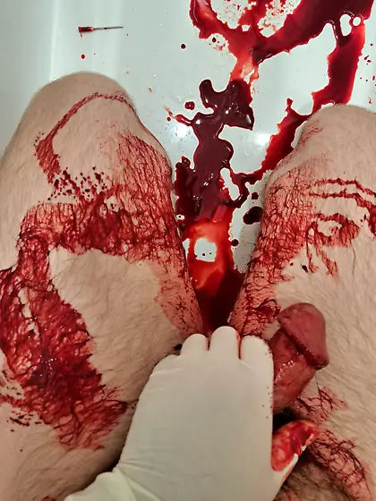 Aftermath of16G needle in my cockhead