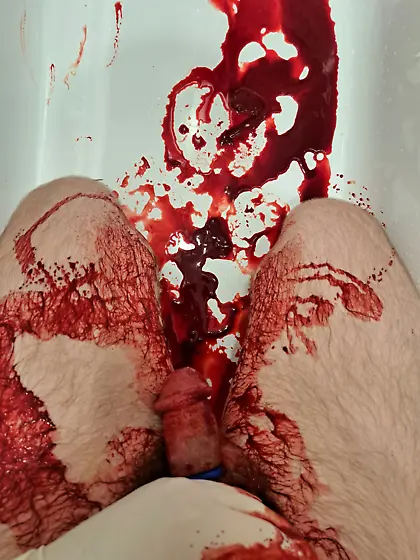 Aftermath of16G needle in my cockhead