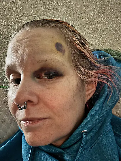 Fell and ended up with a black eye - ain’t it ni