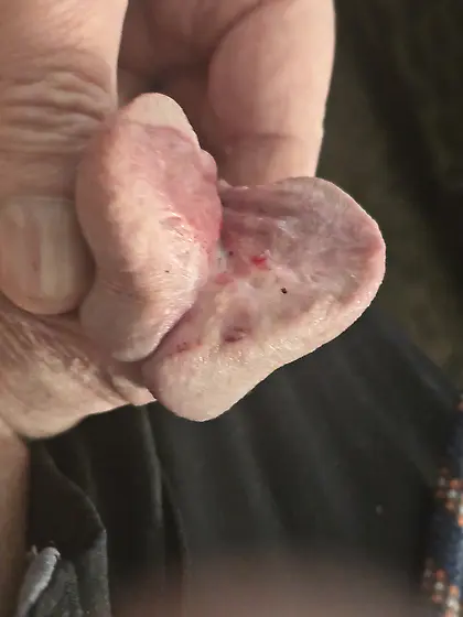 Cutting more of my glans