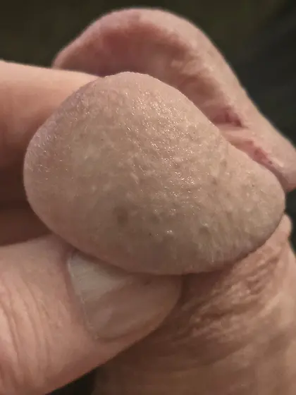 Cutting more of my glans