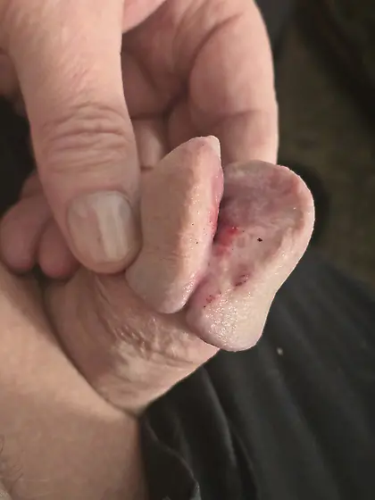 Cutting more of my glans