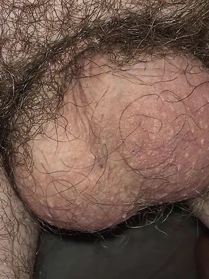 Dickless Bottom - post Penectomy