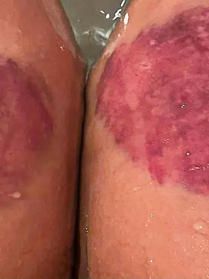 Bite marks on my inner thighs