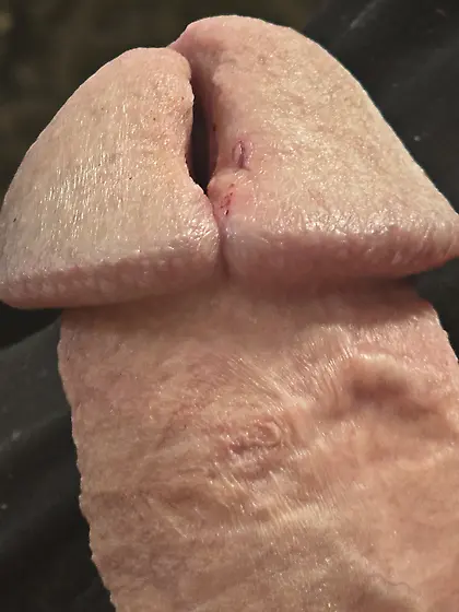 Cutting more of my glans