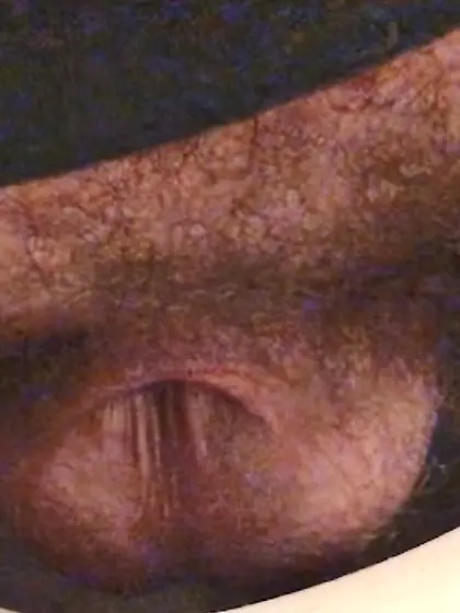 Dickless Bottom - post Penectomy