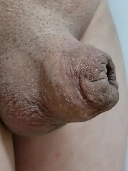 foreskin inflation
