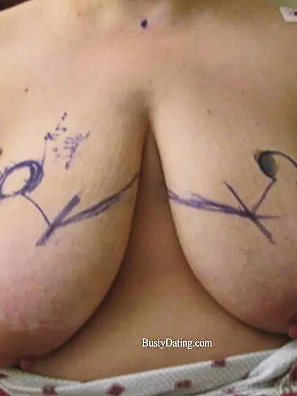 Busty Breast Reductions - Set 26