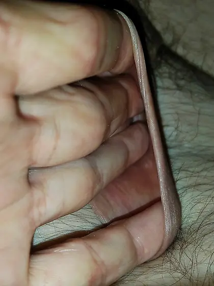 XXL foreskin to be filled with a cock or a big gla