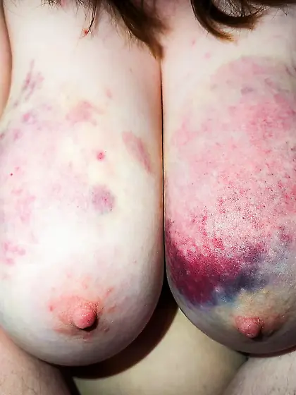 My bruised tits after a rough BDSM session