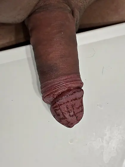 Cauterization healing