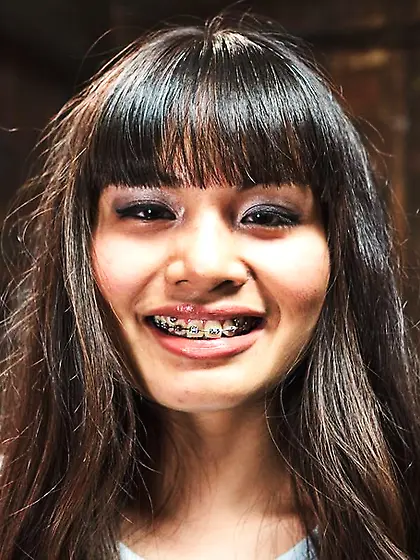 Asian braces teeth feels