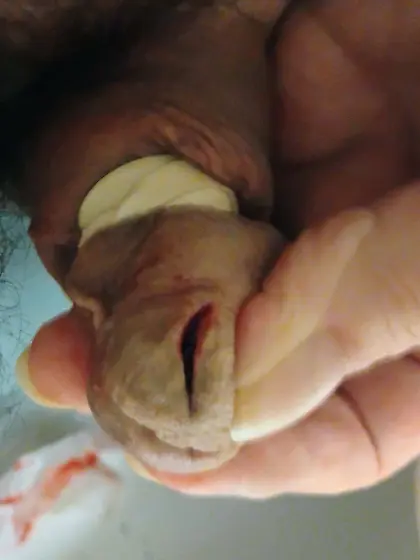 Penectomy Penis