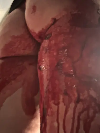 bloody ass