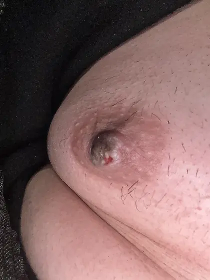 Nipple burn