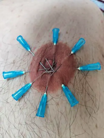 I had my nipples pierced with needles during a mee