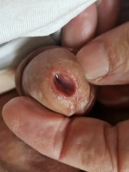 Urethral object insertion