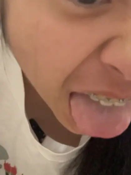 Teen Denise braces accidental downblouse oops