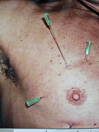 Tits sometimes need Steel inside