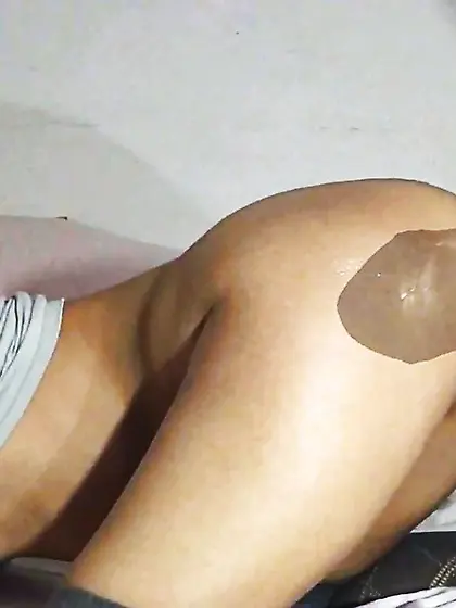 Veneisse x-ray evidence stomach bulbous