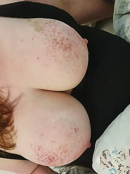 Mrs.  Kink's Bruised Tits
