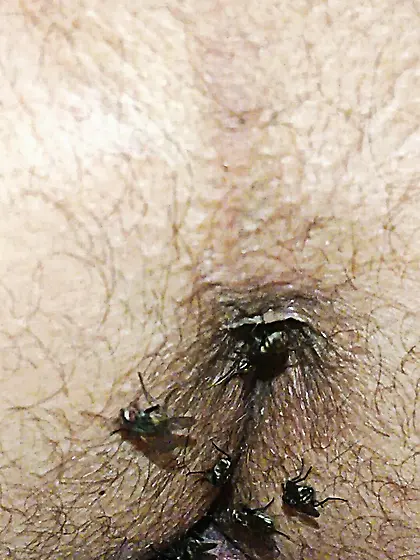 Flies on my anus in the village.  06. 2025