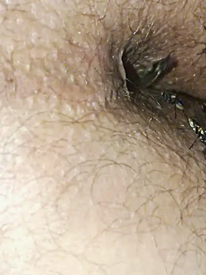 Flies on my anus in the village.  06. 2025